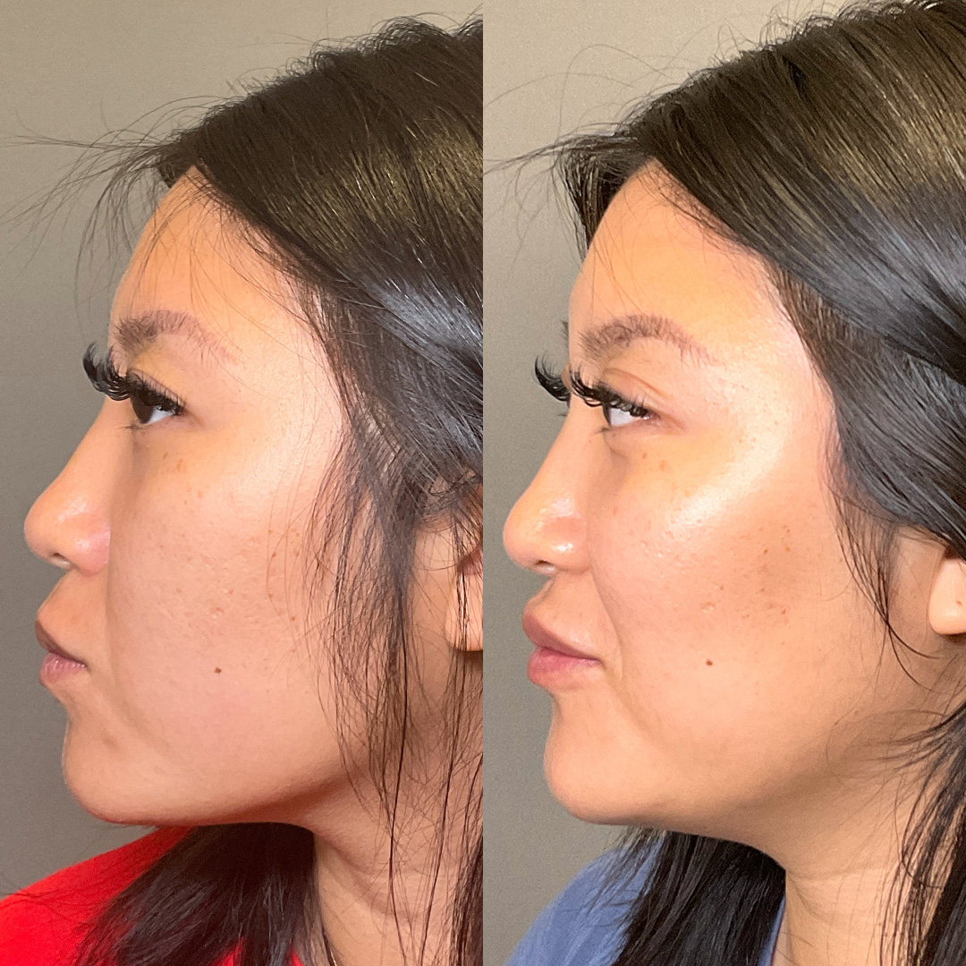 Lip Fillers Before & After Gallery - Patient 384150 - Image 5