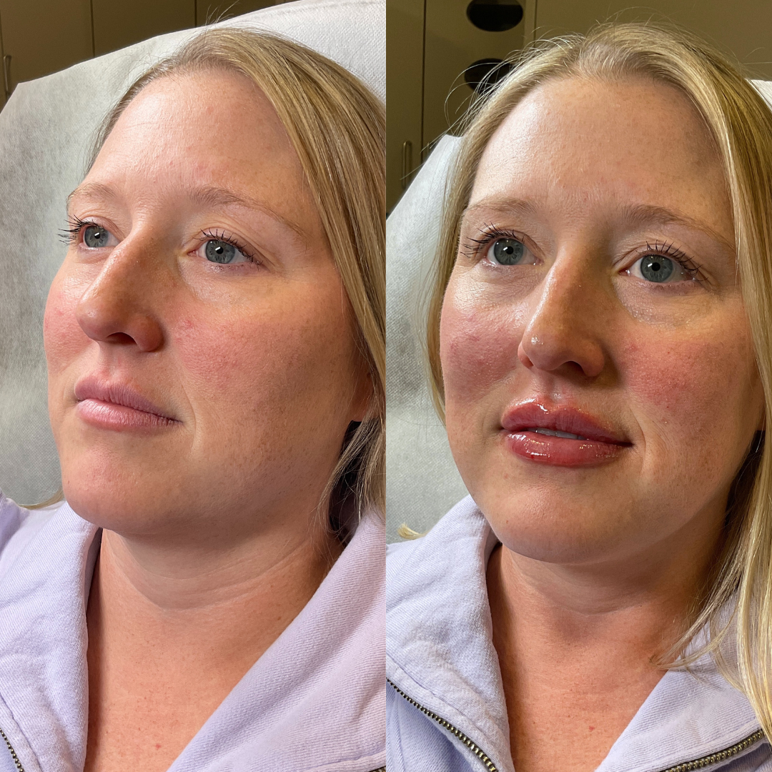Lip Fillers Before & After Gallery - Patient 390204 - Image 1