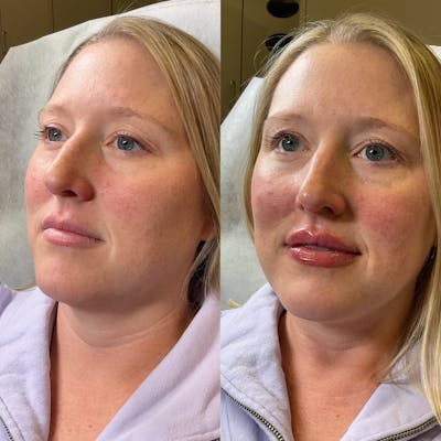 Lip Fillers Before & After Gallery - Patient 390204 - Image 1