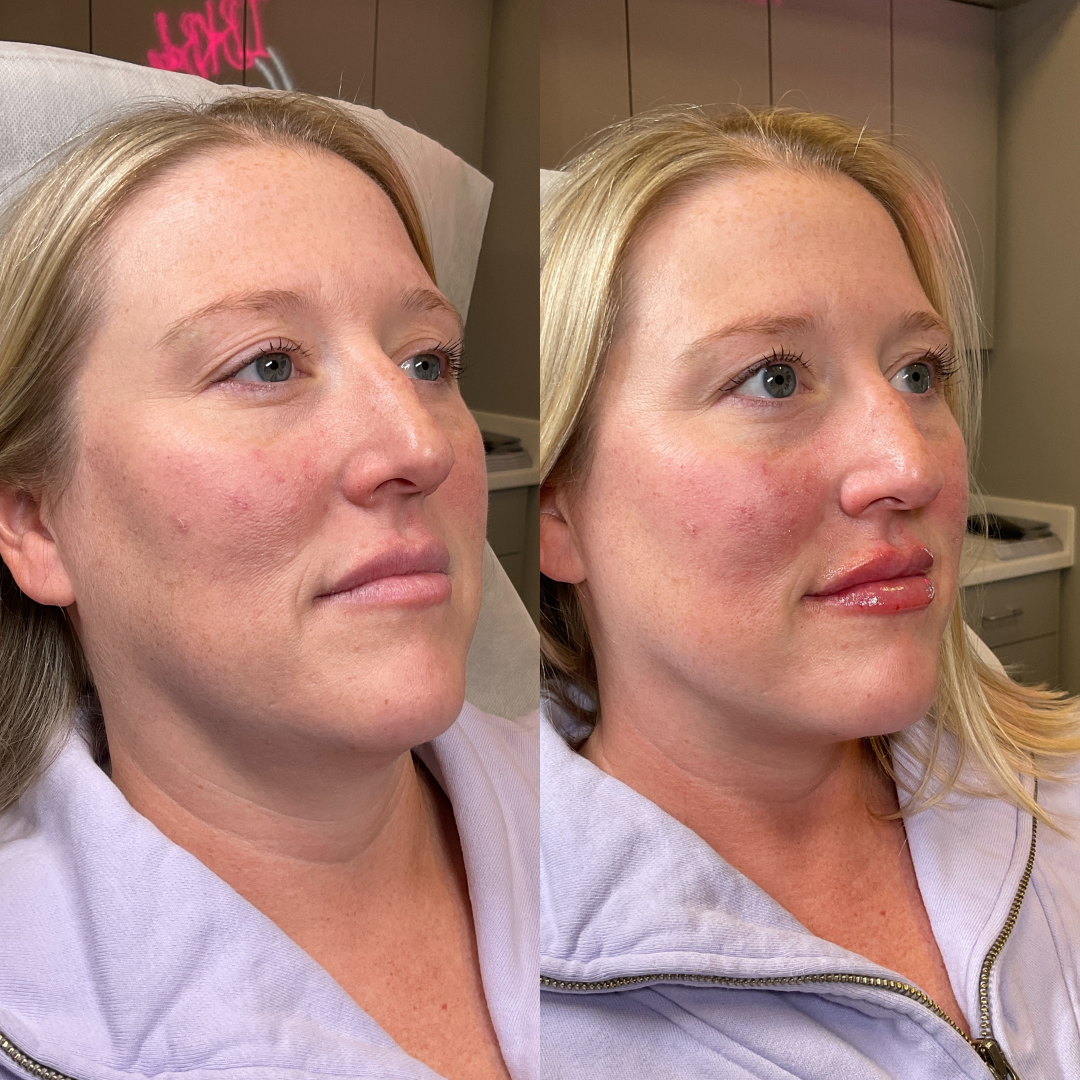 Lip Fillers Before & After Gallery - Patient 390204 - Image 2