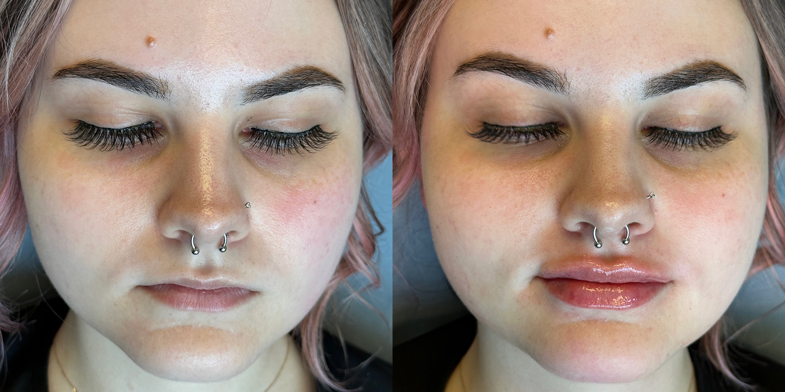 Lip Fillers Before & After Gallery - Patient 410097 - Image 1
