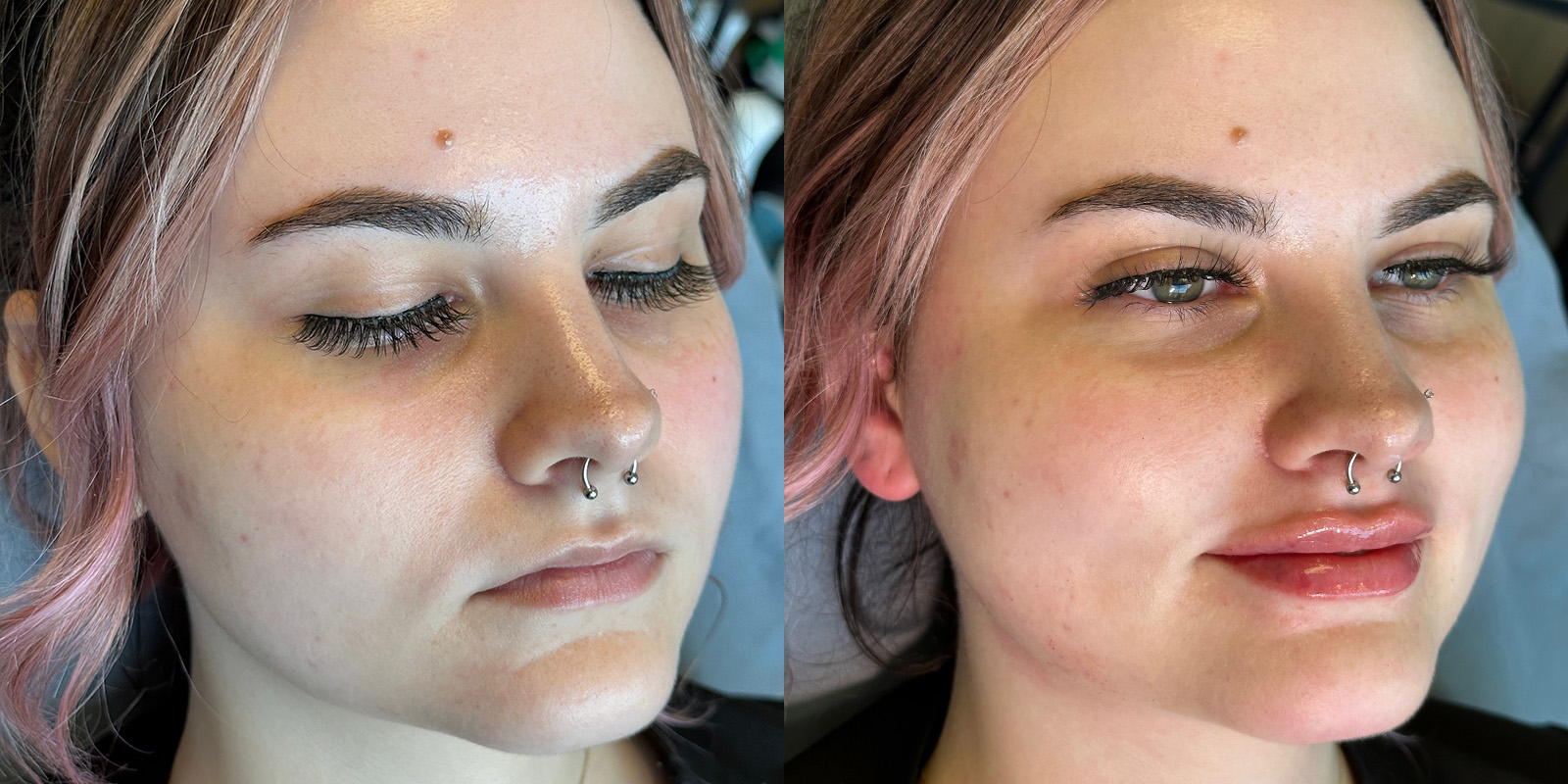 Lip Fillers Before & After Gallery - Patient 410097 - Image 2