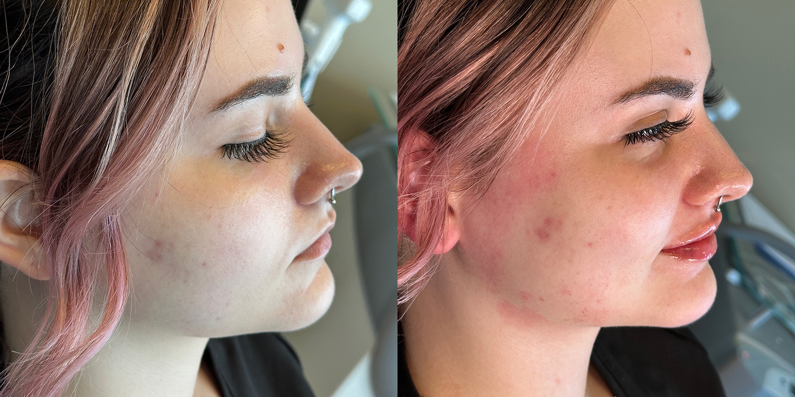 Lip Fillers Before & After Gallery - Patient 410097 - Image 3