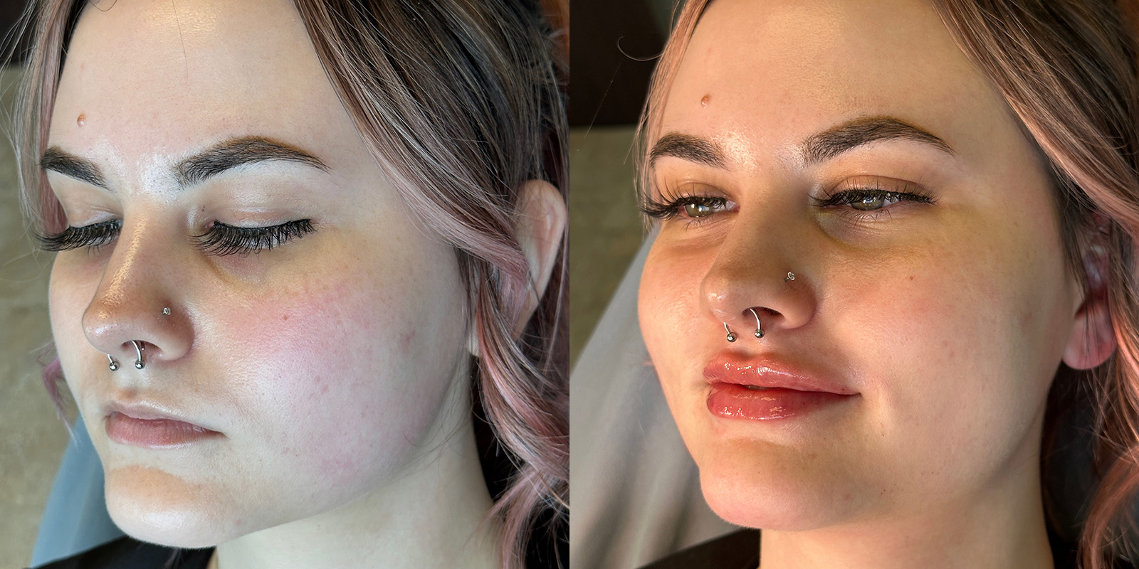 Lip Fillers Before & After Gallery - Patient 410097 - Image 4
