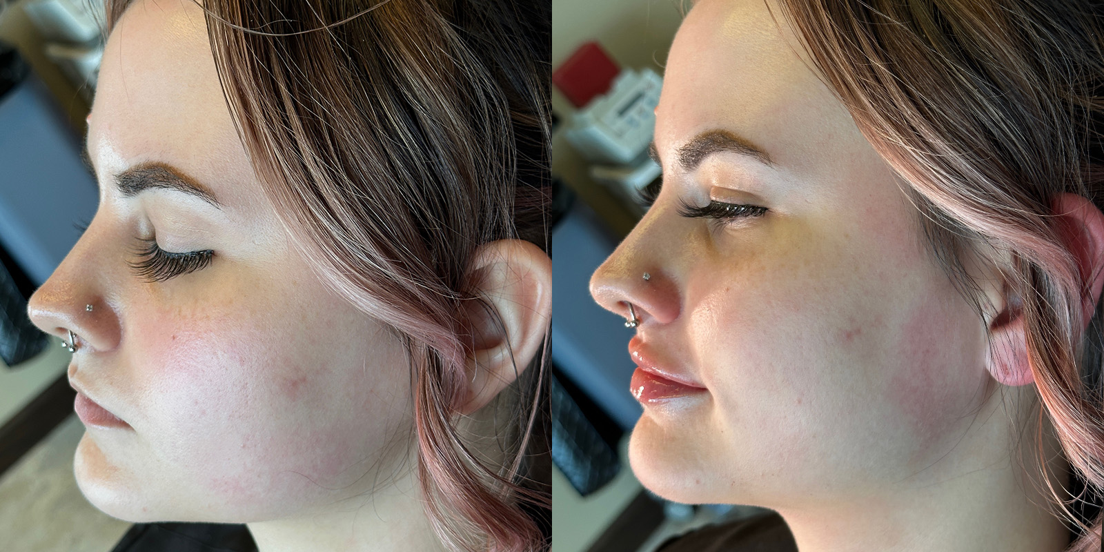 Lip Fillers Before & After Gallery - Patient 410097 - Image 5