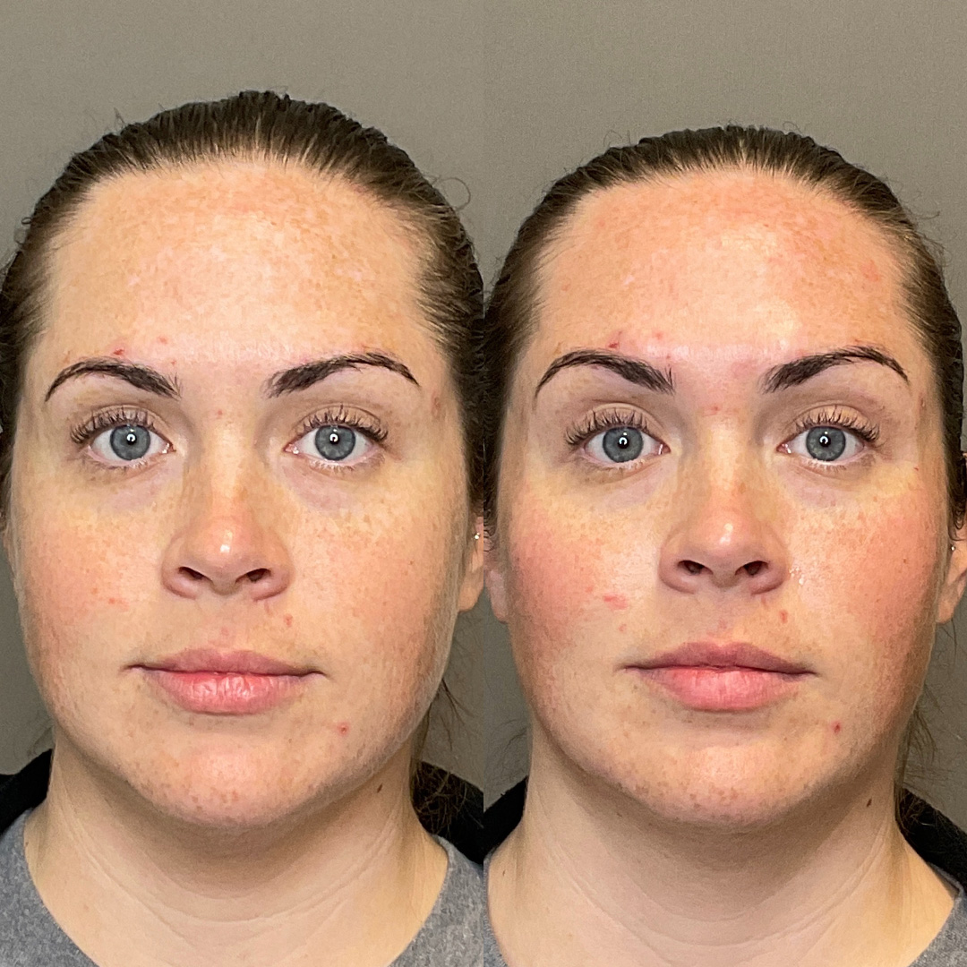 Cheek Filler Before & After Gallery - Patient 119738 - Image 1