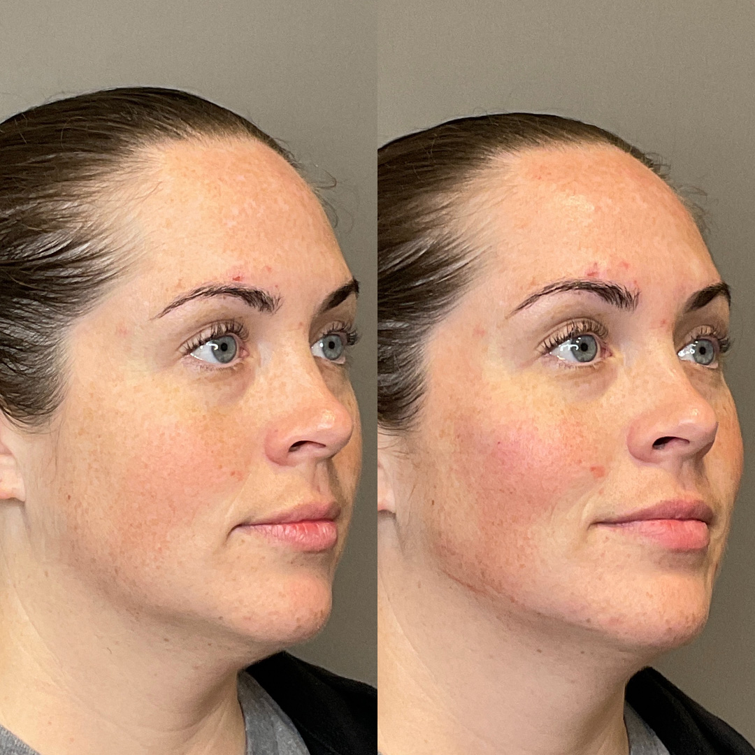 Cheek Filler Before & After Gallery - Patient 119738 - Image 2