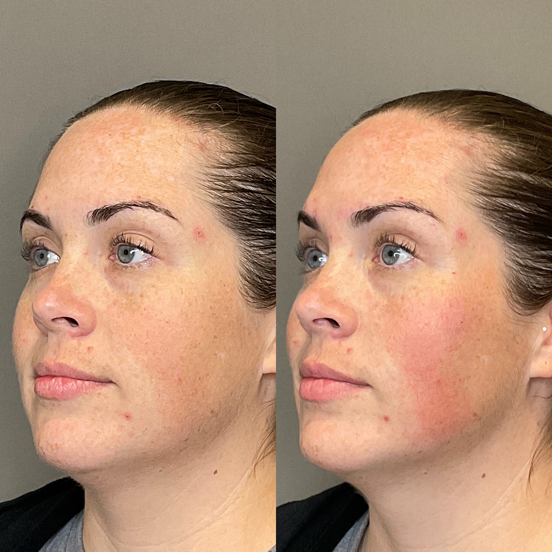Cheek Filler Before & After Gallery - Patient 119738 - Image 3