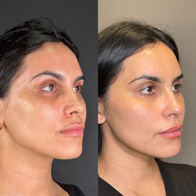 Hydrafacial Before & After Gallery - Patient 299376 - Image 1
