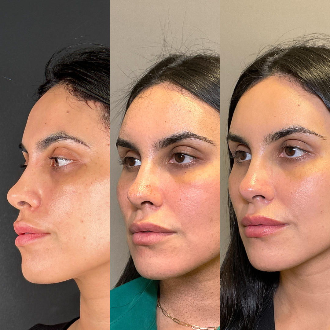 Hydrafacial Before & After Gallery - Patient 299376 - Image 2