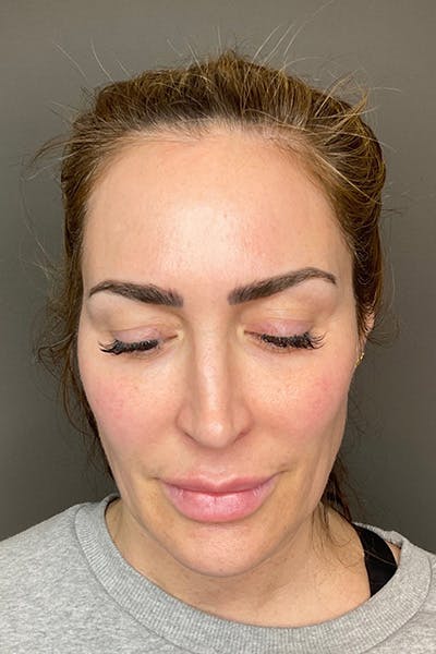 Hydrafacial Before & After Gallery - Patient 268384 - Image 1