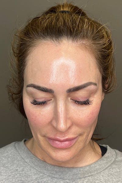 Hydrafacial Before & After Gallery - Patient 268384 - Image 2
