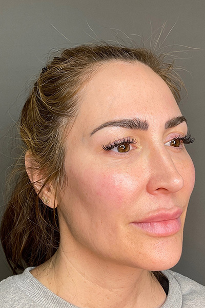 Hydrafacial Before & After Gallery - Patient 268384 - Image 3