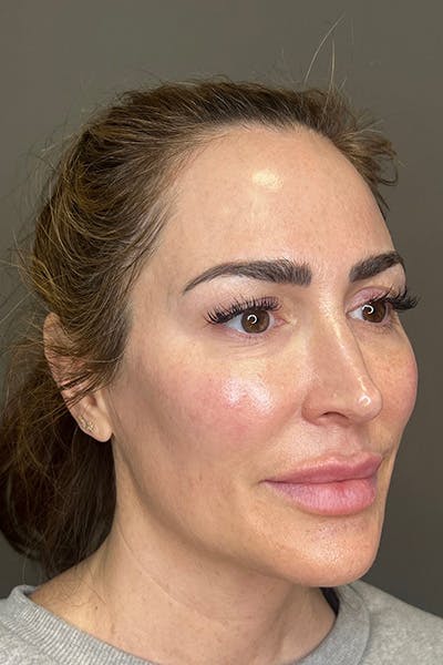 Hydrafacial Before & After Gallery - Patient 268384 - Image 4