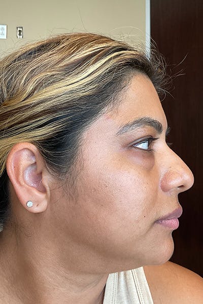 Hydrafacial Before & After Gallery - Patient 414518 - Image 1