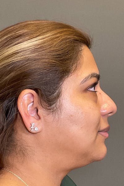 Hydrafacial Before & After Gallery - Patient 414518 - Image 2