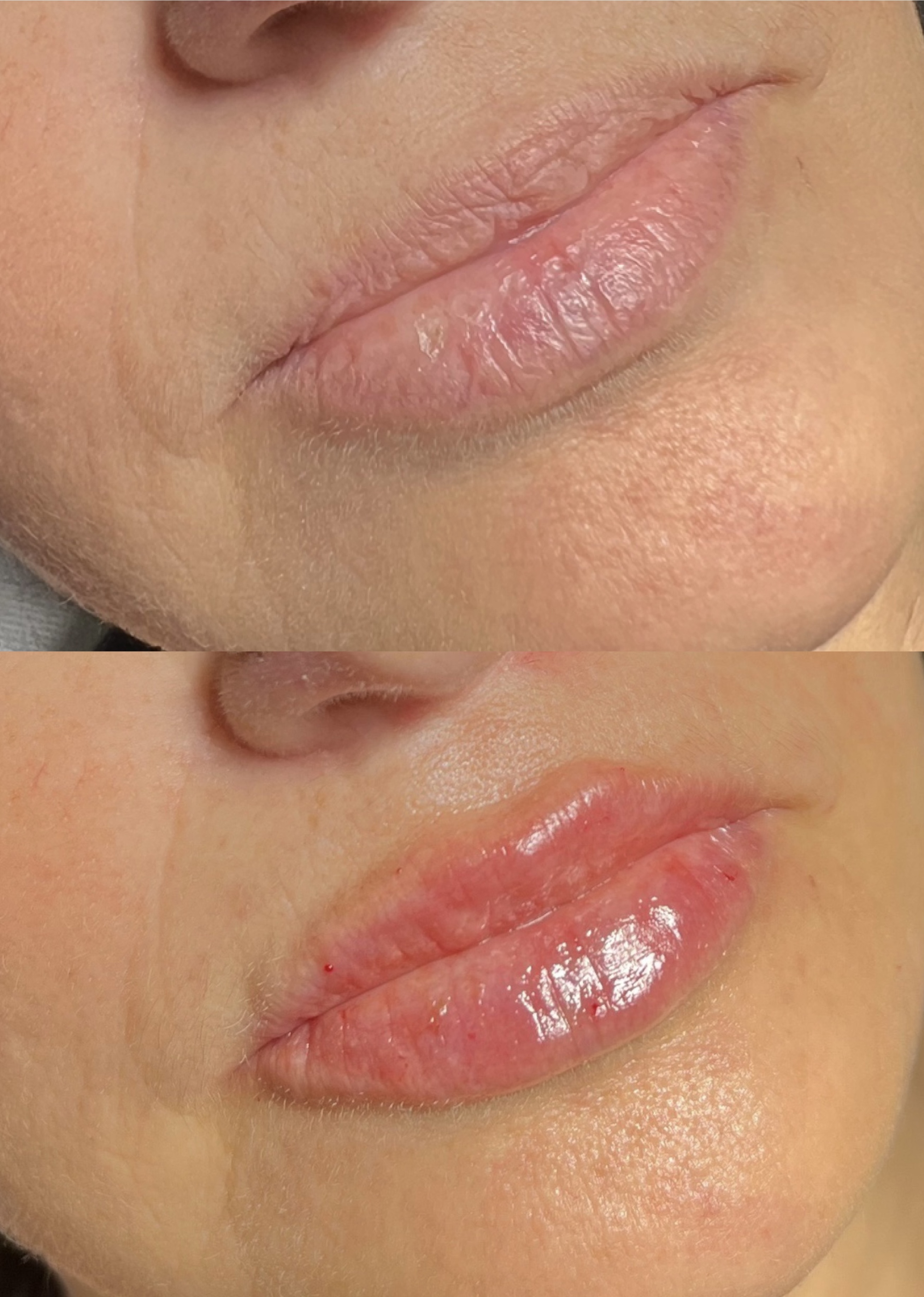 Lip Fillers Before & After Gallery - Patient 270713 - Image 1
