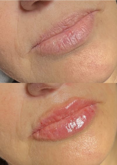 Lip Fillers Before & After Gallery - Patient 270713 - Image 1