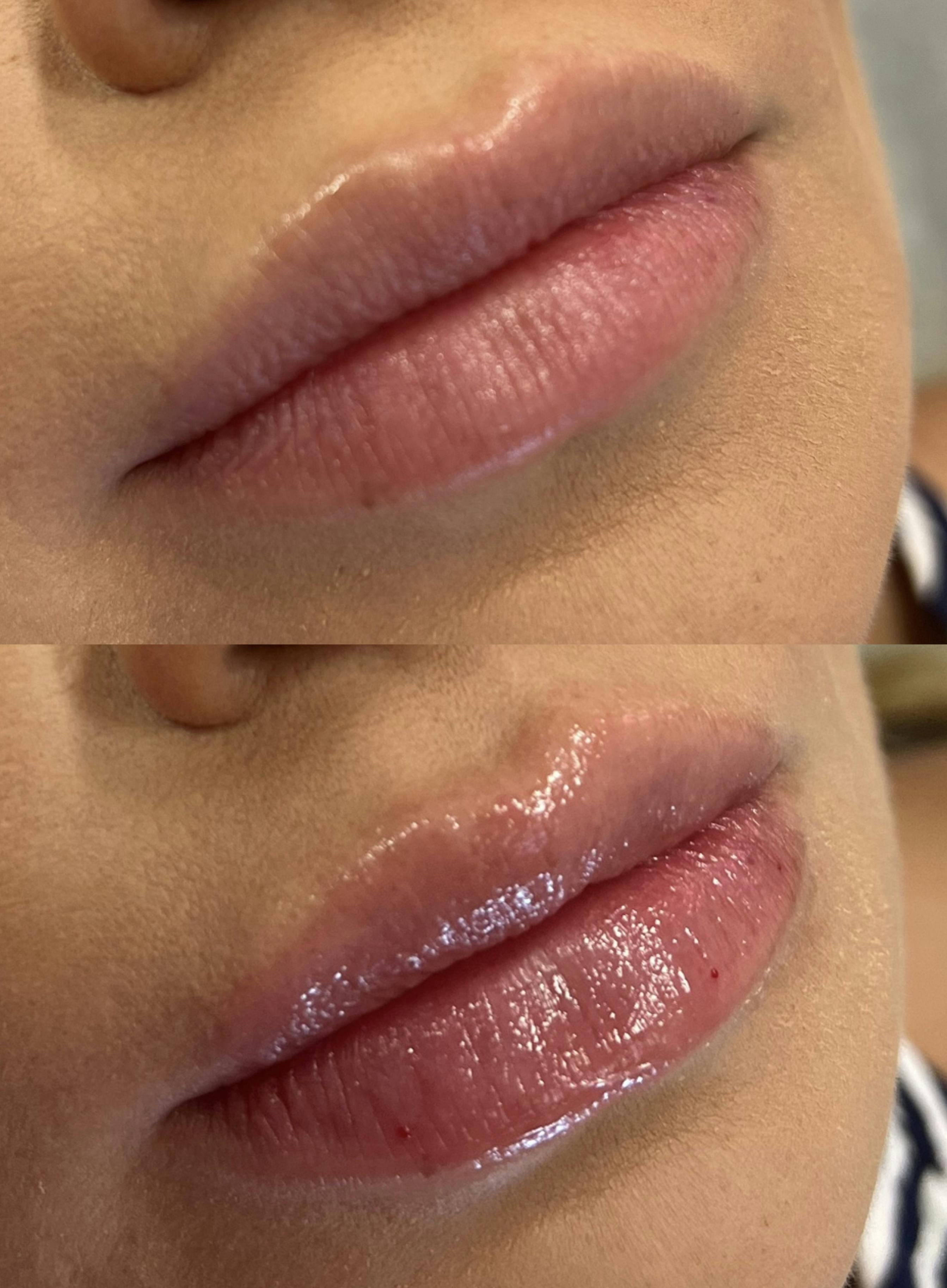 Lip Fillers Before & After Gallery - Patient 288865 - Image 1
