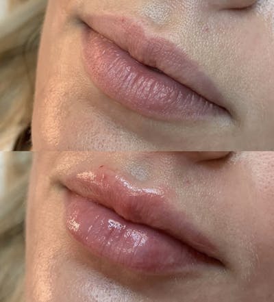 Lip Fillers Before & After Gallery - Patient 269545 - Image 1