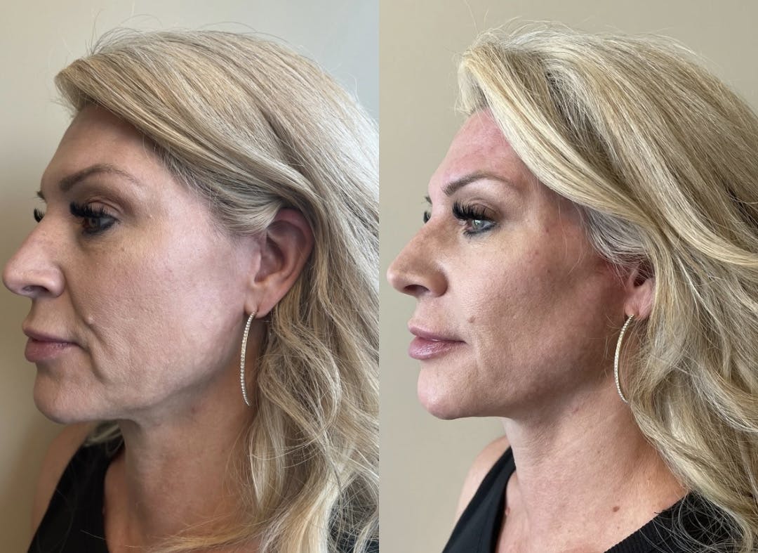 Jawline Contouring  Before & After Gallery - Patient 189451 - Image 1