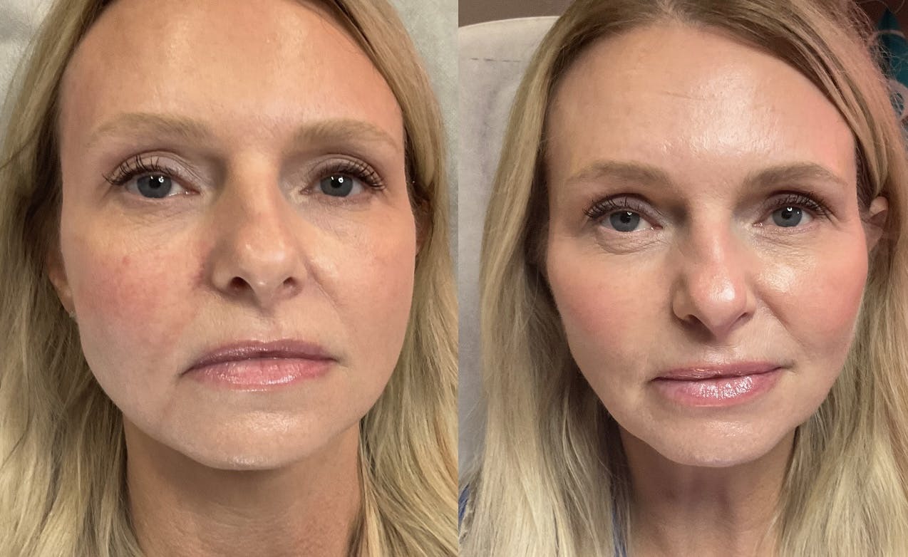 Facial Rejuvenation (Facial Balancing)  Before & After Gallery - Patient 135645 - Image 1