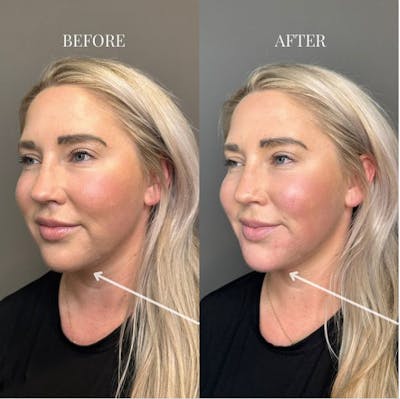 Chin Before & After Gallery - Patient 650835 - Image 1