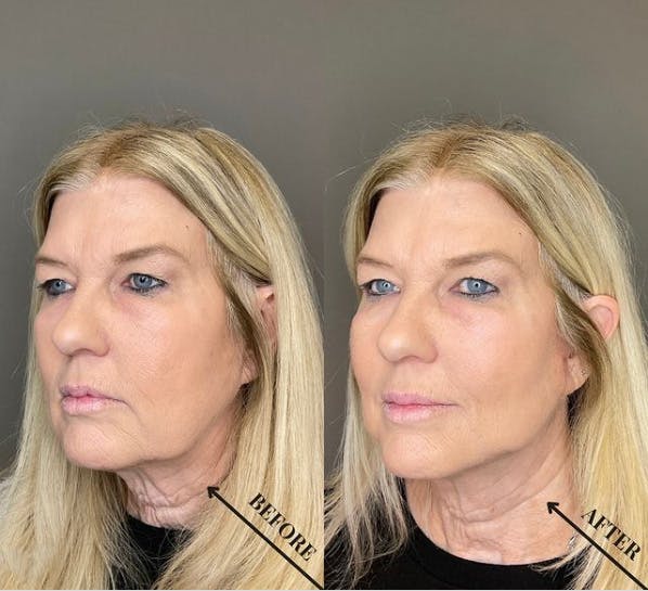 Jawline Contouring  Before & After Gallery - Patient 404812 - Image 1