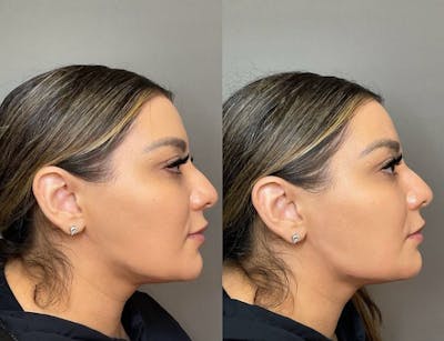 Jawline Contouring  Before & After Gallery - Patient 205552 - Image 1