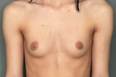 Breast Augmentation Before & After Gallery - Patient 271586 - Image 1