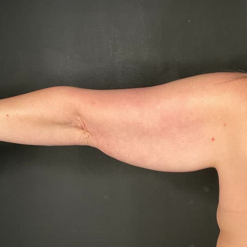 Armlift (Brachioplasty) Before & After Gallery - Patient 358915 - Image 1