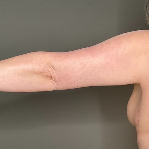 Armlift (Brachioplasty) Before & After Gallery - Patient 358915 - Image 2