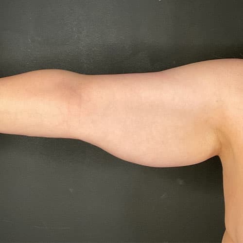 Armlift (Brachioplasty) Before & After Gallery - Patient 358915 - Image 3