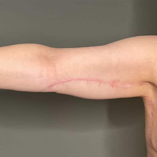 Armlift (Brachioplasty) Before & After Gallery - Patient 358915 - Image 4