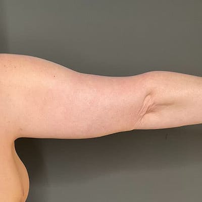 Armlift (Brachioplasty) Before & After Gallery - Patient 358915 - Image 6