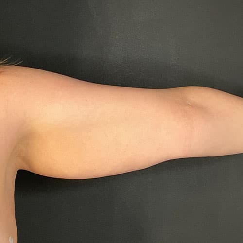 Armlift (Brachioplasty) Before & After Gallery - Patient 358915 - Image 7