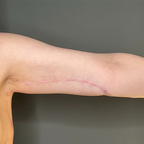 Armlift (Brachioplasty) Before & After Gallery - Patient 358915 - Image 8