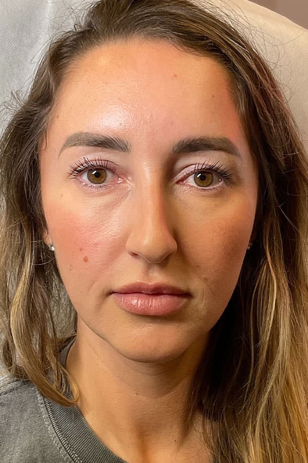 Facial Rejuvenation (Facial Balancing)  Before & After Gallery - Patient 420004 - Image 1