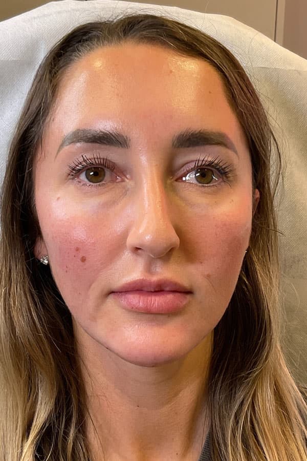 Facial Rejuvenation (Facial Balancing)  Before & After Gallery - Patient 420004 - Image 2