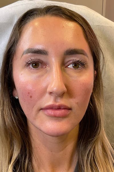 Facial Rejuvenation (Facial Balancing)  Before & After Gallery - Patient 420004 - Image 2