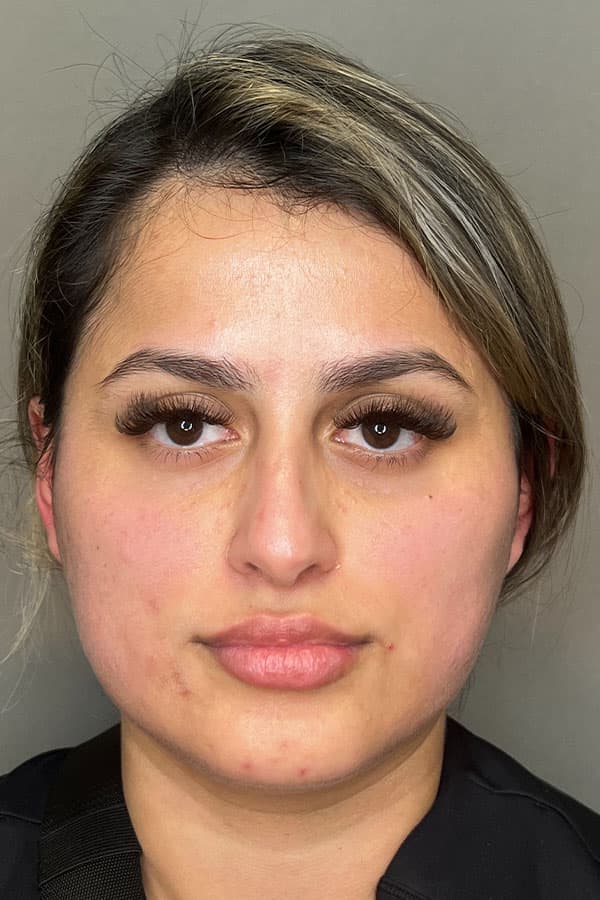 Lip Fillers Before & After Gallery - Patient 396046 - Image 1