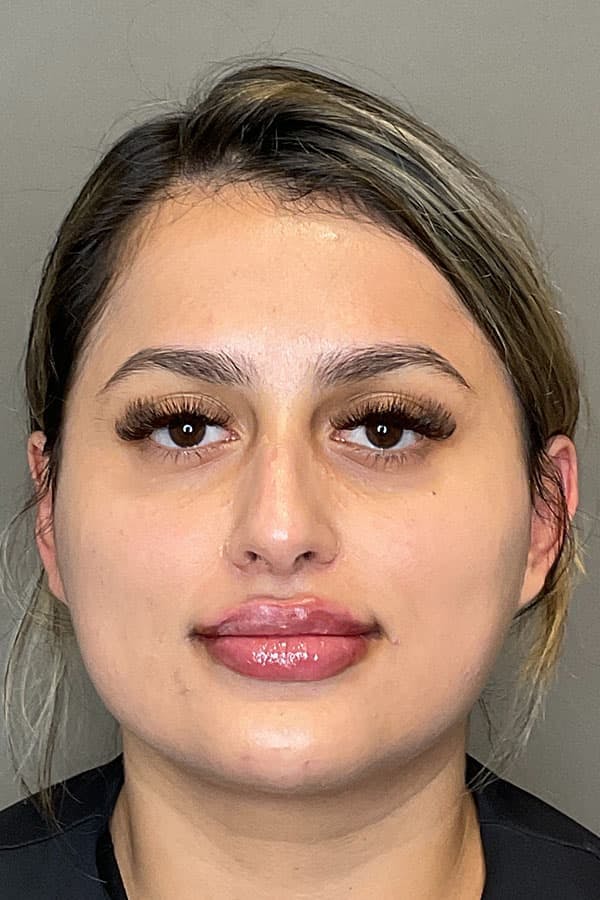 Lip Fillers Before & After Gallery - Patient 396046 - Image 2