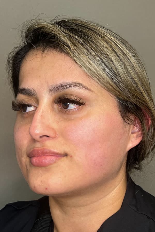 Lip Fillers Before & After Gallery - Patient 396046 - Image 3