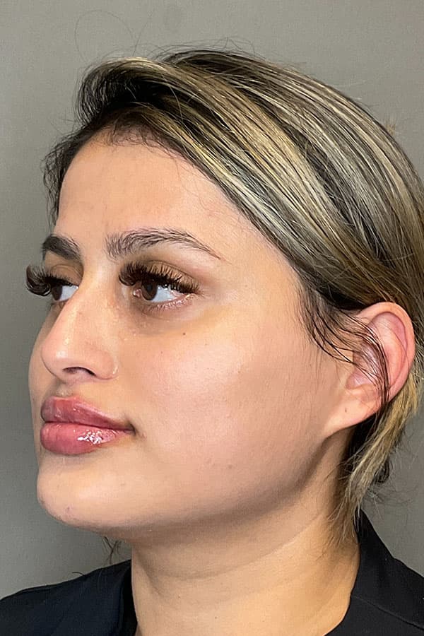 Lip Fillers Before & After Gallery - Patient 396046 - Image 4