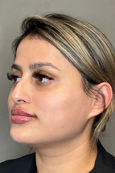 Lip Fillers Before & After Gallery - Patient 396046 - Image 4