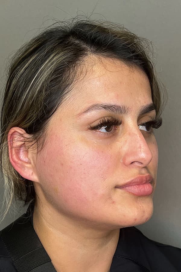 Lip Fillers Before & After Gallery - Patient 396046 - Image 5