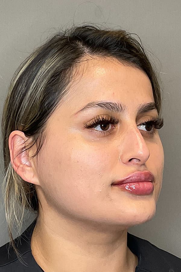 Lip Fillers Before & After Gallery - Patient 396046 - Image 6