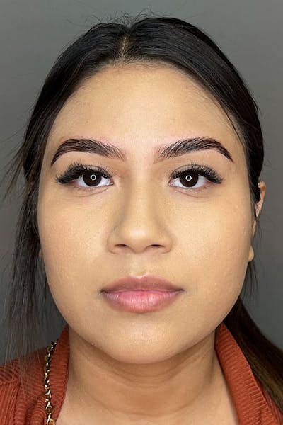 Lip Fillers Before & After Gallery - Patient 108125 - Image 1