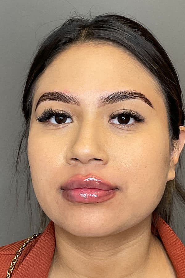 Lip Fillers Before & After Gallery - Patient 108125 - Image 2