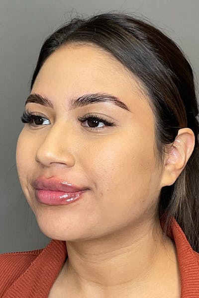 Lip Fillers Before & After Gallery - Patient 108125 - Image 4